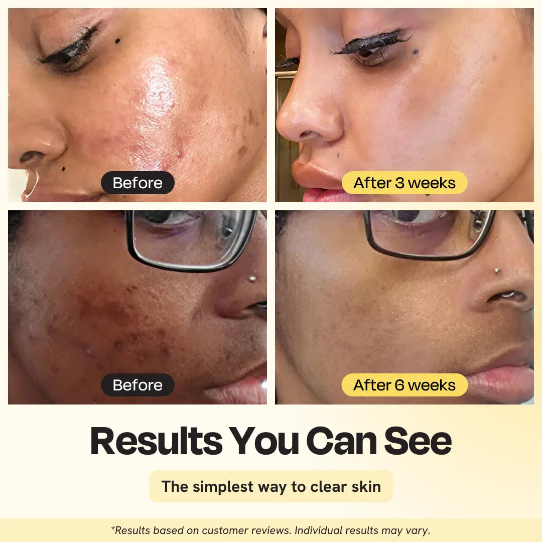Gleamin Dark Spot Heroes